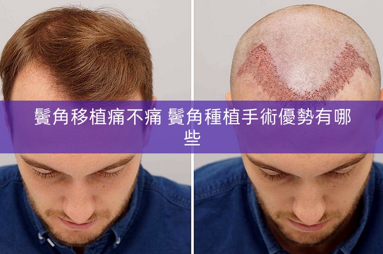 鬢角移植痛不痛 鬢角種植手術優勢有哪些