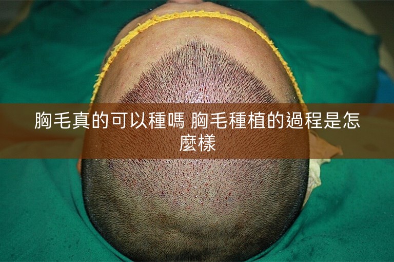 胸毛真的可以種嗎 胸毛種植的過程是怎麼樣 胸毛真的可以種嗎 胸毛種植的過程是怎麼樣