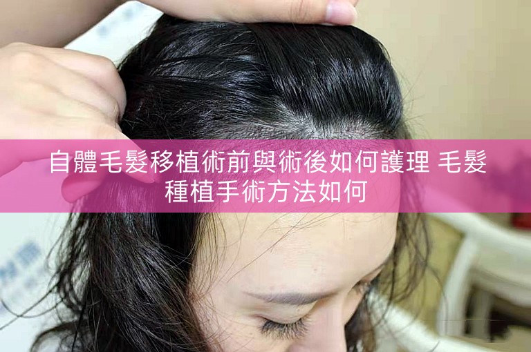 自體毛髮移植術前與術後如何護理 毛髮種植手術方法如何 自體毛髮移植術前與術後如何護理 毛髮種植手術方法如何