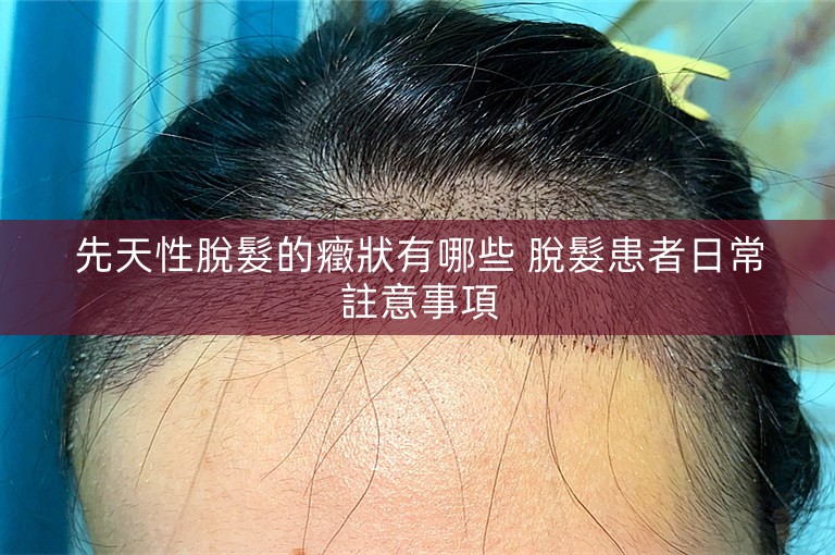 先天性脫髮的癥狀有哪些 脫髮患者日常註意事項