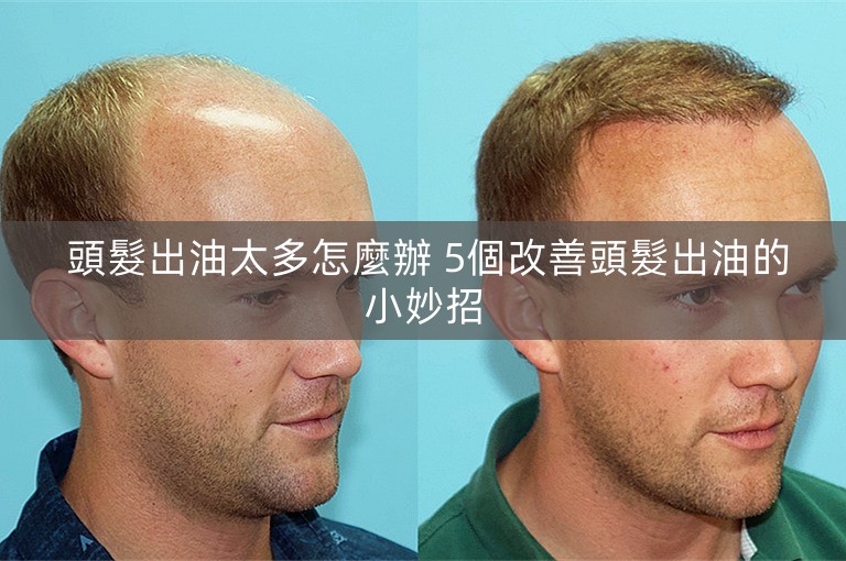 頭髮出油太多怎麼辦 5個改善頭髮出油的小妙招 頭髮出油太多怎麼辦 5個改善頭髮出油的小妙招