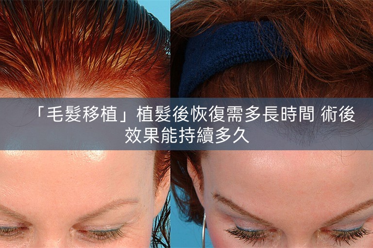 「毛髮移植」植髮後恢復需多長時間 術後效果能持續多久