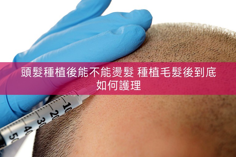 頭髮種植後能不能燙髮 種植毛髮後到底如何護理 頭髮種植後能不能燙髮 種植毛髮後到底如何護理
