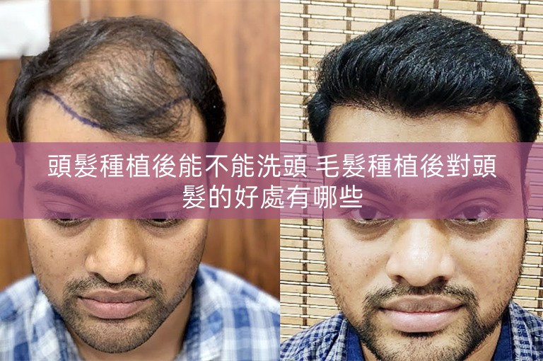 頭髮種植後能不能洗頭 毛髮種植後對頭髮的好處有哪些 頭髮種植後能不能洗頭 毛髮種植後對頭髮的好處有哪些