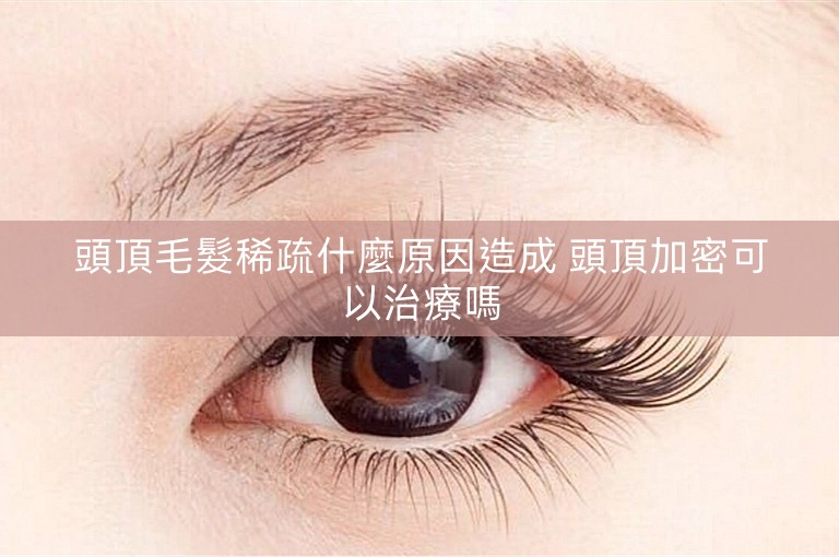 頭頂毛髮稀疏什麼原因造成 頭頂加密可以治療嗎