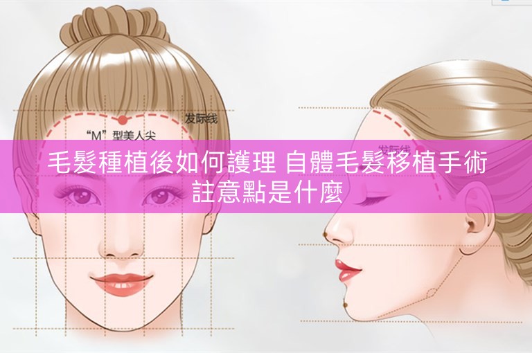 毛髮種植後如何護理 自體毛髮移植手術註意點是什麼
