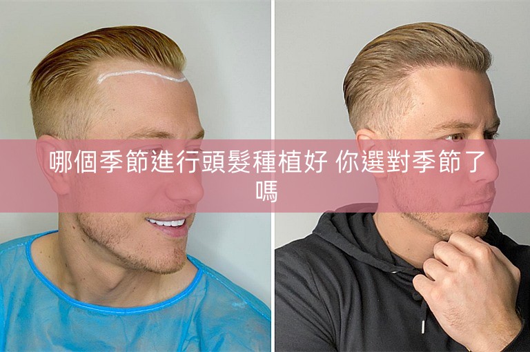 哪個季節進行頭髮種植好 你選對季節了嗎