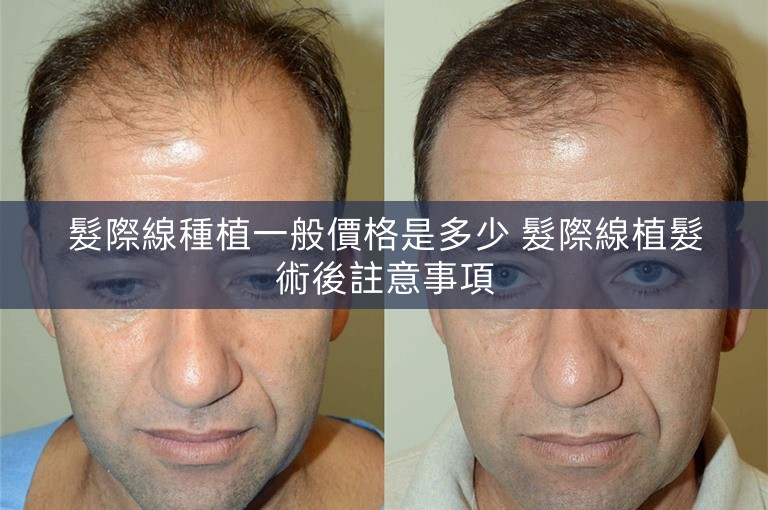 髮際線種植一般價格是多少 髮際線植髮術後註意事項