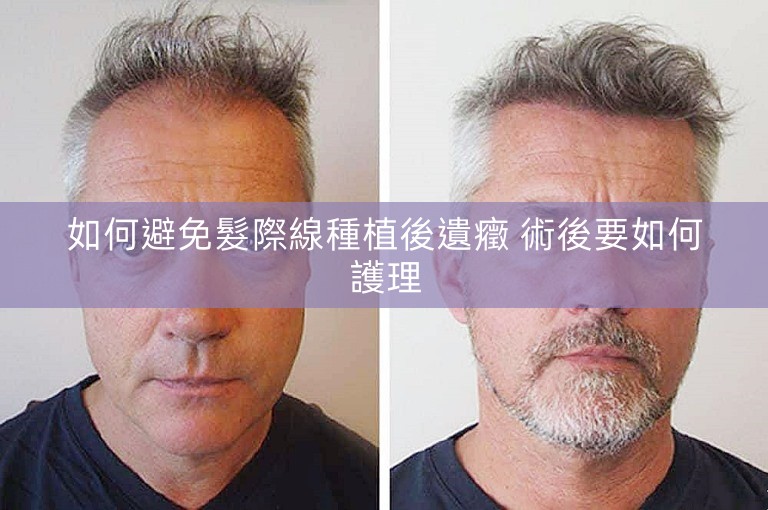 如何避免髮際線種植後遺癥 術後要如何護理 如何避免髮際線種植後遺癥 術後要如何護理