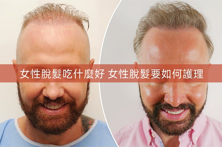 女性脫髮吃什麼好 女性脫髮要如何護理 女性脫髮吃什麼好 女性脫髮要如何護理
