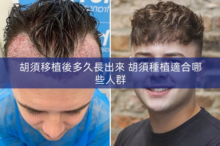 胡須移植後多久長出來 胡須種植適合哪些人群 胡須移植後多久長出來 胡須種植適合哪些人群