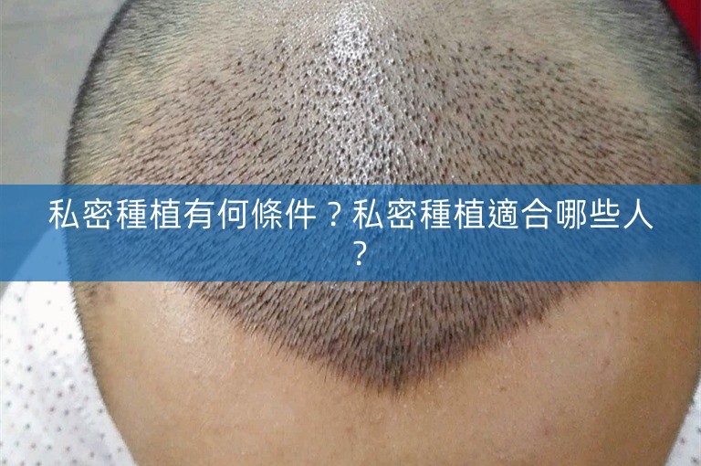 私密種植有何條件?私密種植適合哪些人? 私密種植有何條件?私密種植適合哪些人?