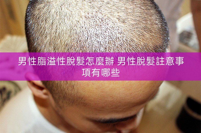 男性脂溢性脫髮怎麼辦 男性脫髮註意事項有哪些