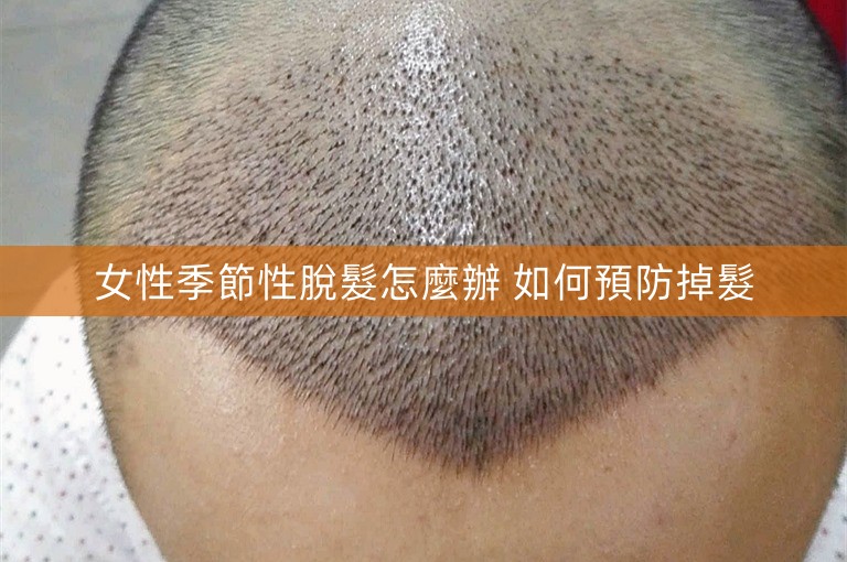 女性季節性脫髮怎麼辦 如何預防掉髮