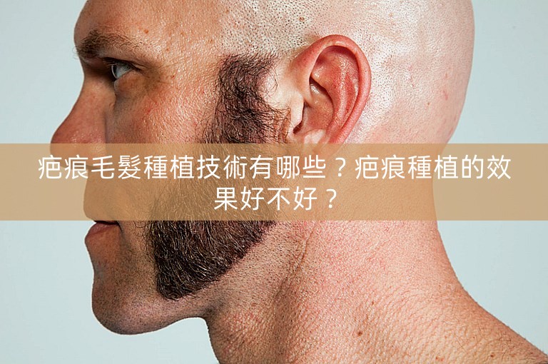 疤痕毛髮種植技術有哪些?疤痕種植的效果好不好? 疤痕毛髮種植技術有哪些?疤痕種植的效果好不好?