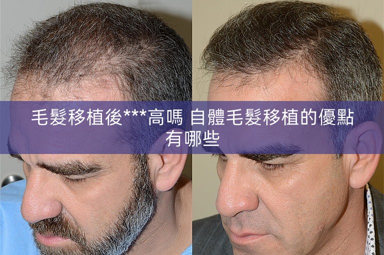 毛髮移植後***高嗎 自體毛髮移植的優點有哪些 毛髮移植後***高嗎 自體毛髮移植的優點有哪些