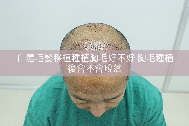 自體毛髮移植種植胸毛好不好 胸毛種植後會不會脫落 自體毛髮移植種植胸毛好不好 胸毛種植後會不會脫落