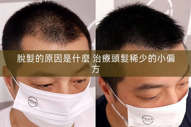 脫髮的原因是什麼 治療頭髮稀少的小偏方