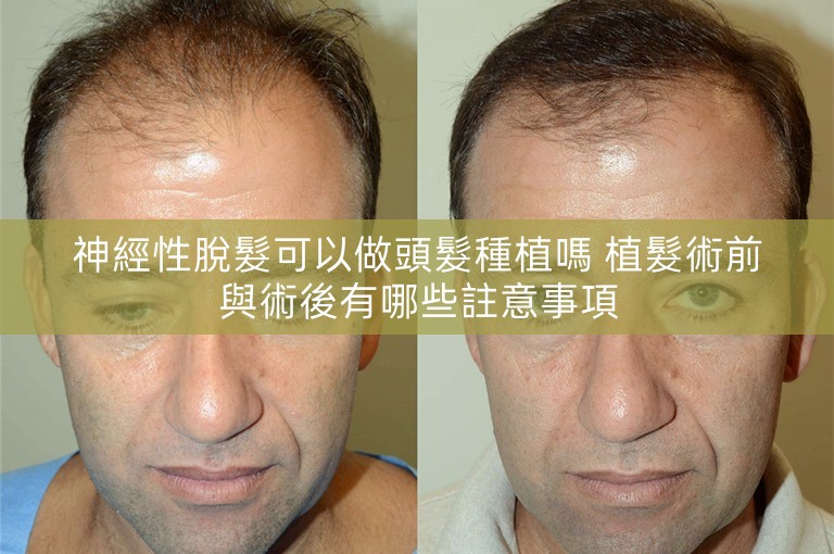 神經性脫髮可以做頭髮種植嗎 植髮術前與術後有哪些註意事項