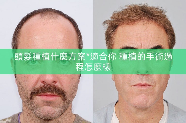 頭髮種植什麼方案*適合你 種植的手術過程怎麼樣