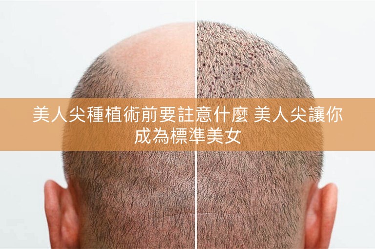 美人尖種植術前要註意什麼 美人尖讓你成為標準美女