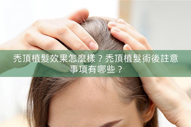 禿頂植髮效果怎麼樣？禿頂植髮術後註意事項有哪些？