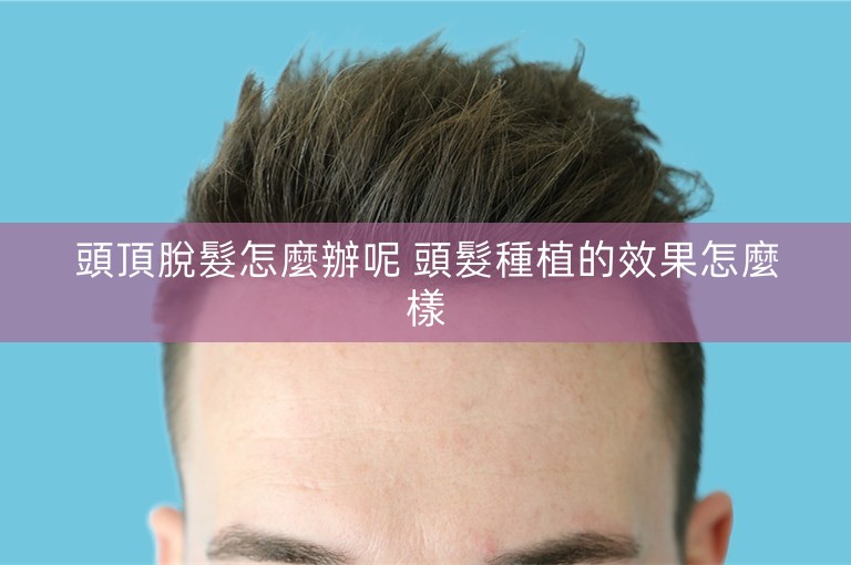 頭頂脫髮怎麼辦呢 頭髮種植的效果怎麼樣 頭頂脫髮怎麼辦呢 頭髮種植的效果怎麼樣