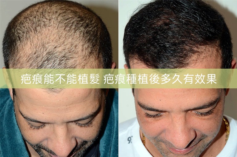 疤痕能不能植髮 疤痕種植後多久有效果