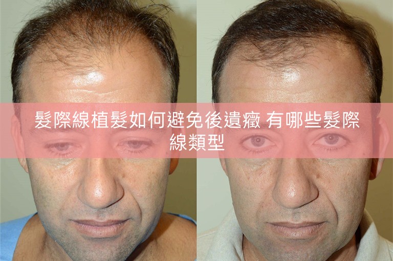 髮際線植髮如何避免後遺癥 有哪些髮際線類型