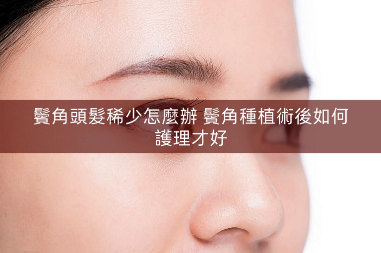 鬢角頭髮稀少怎麼辦 鬢角種植術後如何護理才好