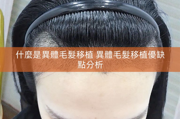 什麼是異體毛髮移植 異體毛髮移植優缺點分析 什麼是異體毛髮移植 異體毛髮移植優缺點分析