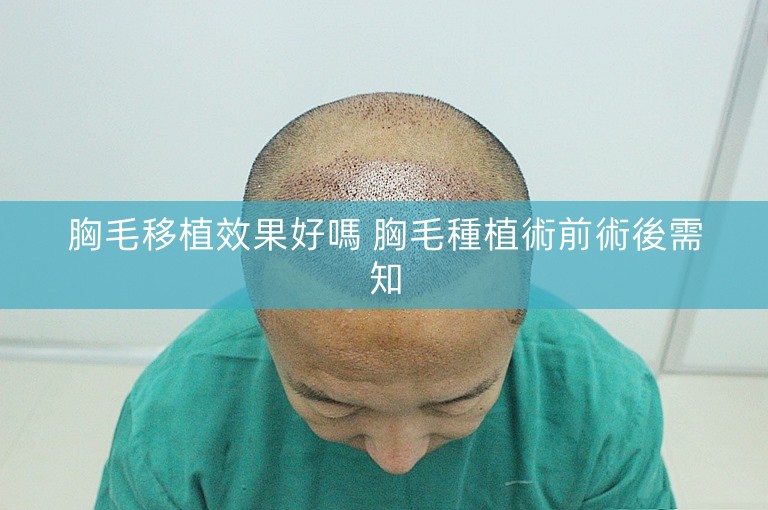 胸毛移植效果好嗎 胸毛種植術前術後需知 胸毛移植效果好嗎 胸毛種植術前術後需知