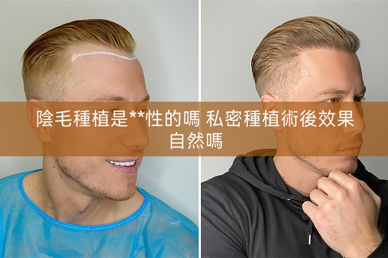 陰毛種植是**性的嗎 私密種植術後效果自然嗎