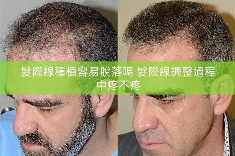 髮際線種植容易脫落嗎 髮際線調整過程中疼不疼