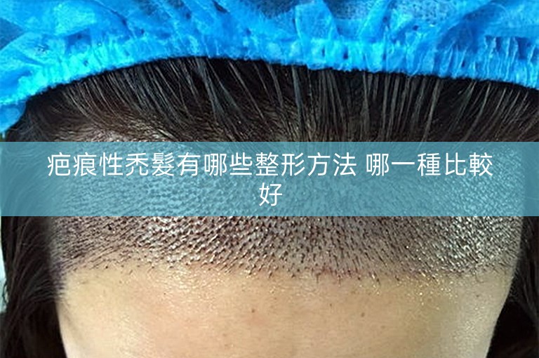 疤痕性禿髮有哪些整形方法 哪一種比較好