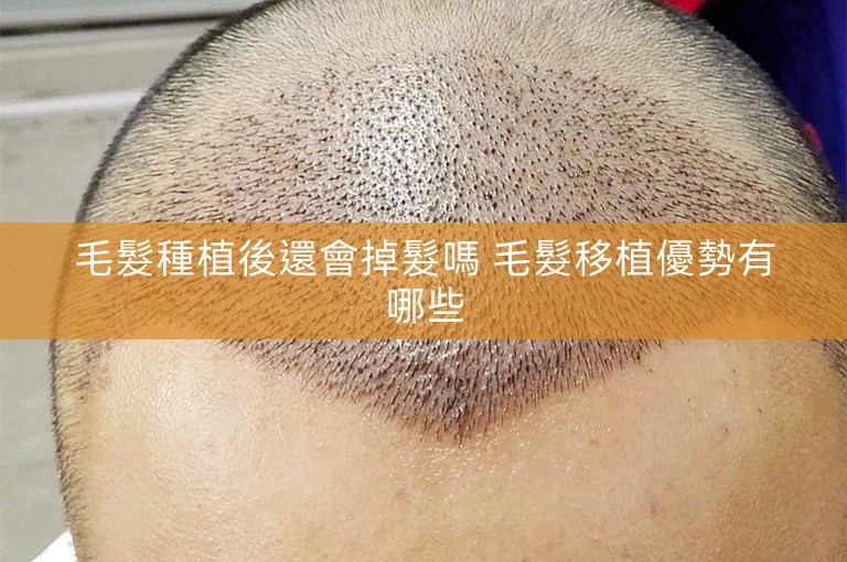 毛髮種植後還會掉髮嗎 毛髮移植優勢有哪些