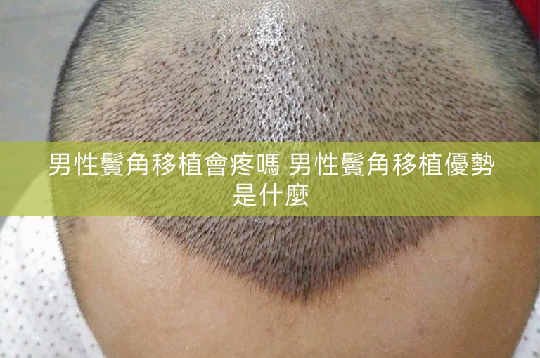 男性鬢角移植會疼嗎 男性鬢角移植優勢是什麼
