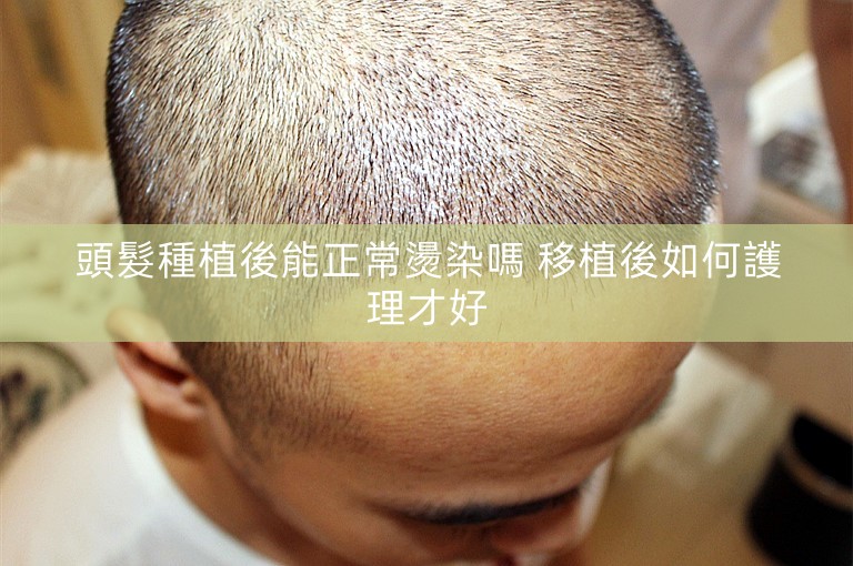 頭髮種植後能正常燙染嗎 移植後如何護理才好 頭髮種植後能正常燙染嗎 移植後如何護理才好