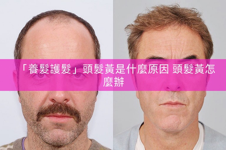 「養髮護髮」頭髮黃是什麼原因 頭髮黃怎麼辦
