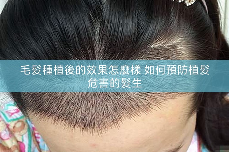 毛髮種植後的效果怎麼樣 如何預防植髮危害的髮生