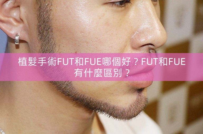 植髮手術FUT和FUE哪個好?FUT和FUE有什麼區別? 植髮手術FUT和FUE哪個好?FUT和FUE有什麼區別?