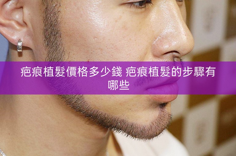 疤痕植髮價格多少錢 疤痕植髮的步驟有哪些