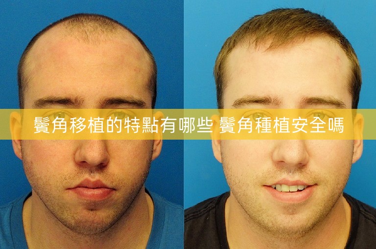 鬢角移植的特點有哪些 鬢角種植安全嗎