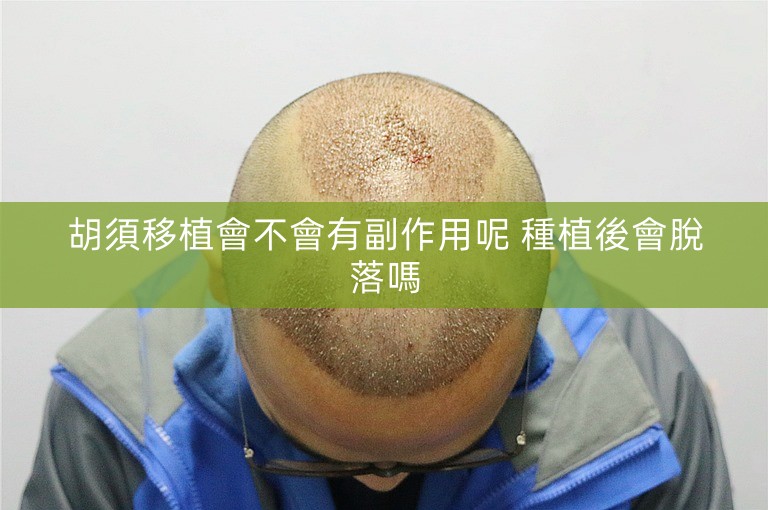 胡須移植會不會有副作用呢 種植後會脫落嗎