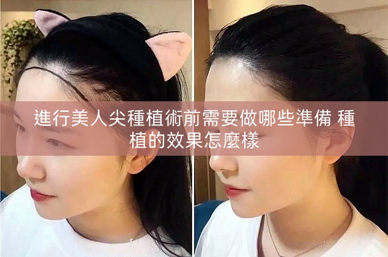 進行美人尖種植術前需要做哪些準備 種植的效果怎麼樣