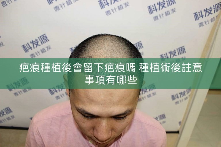 疤痕種植後會留下疤痕嗎 種植術後註意事項有哪些