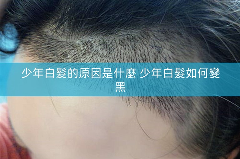 少年白髮的原因是什麼 少年白髮如何變黑 少年白髮的原因是什麼 少年白髮如何變黑