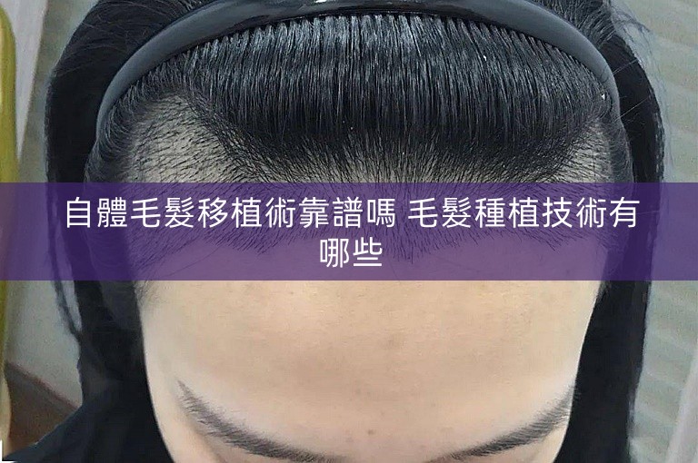 自體毛髮移植術靠譜嗎 毛髮種植技術有哪些