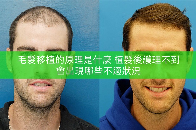 毛髮移植的原理是什麼 植髮後護理不到會出現哪些不適狀況 毛髮移植的原理是什麼 植髮後護理不到會出現哪些不適狀況