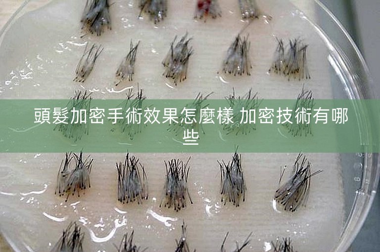 頭髮加密手術效果怎麼樣 加密技術有哪些